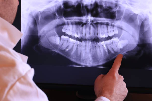 Best Emergency Tooth Extraction in Urbana, MD