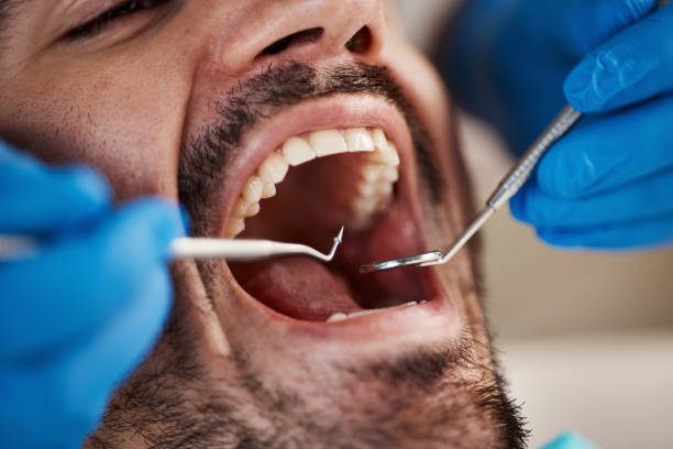 Best Emergency Treatment for Dental Infections or Abscesses in Urbana, MD